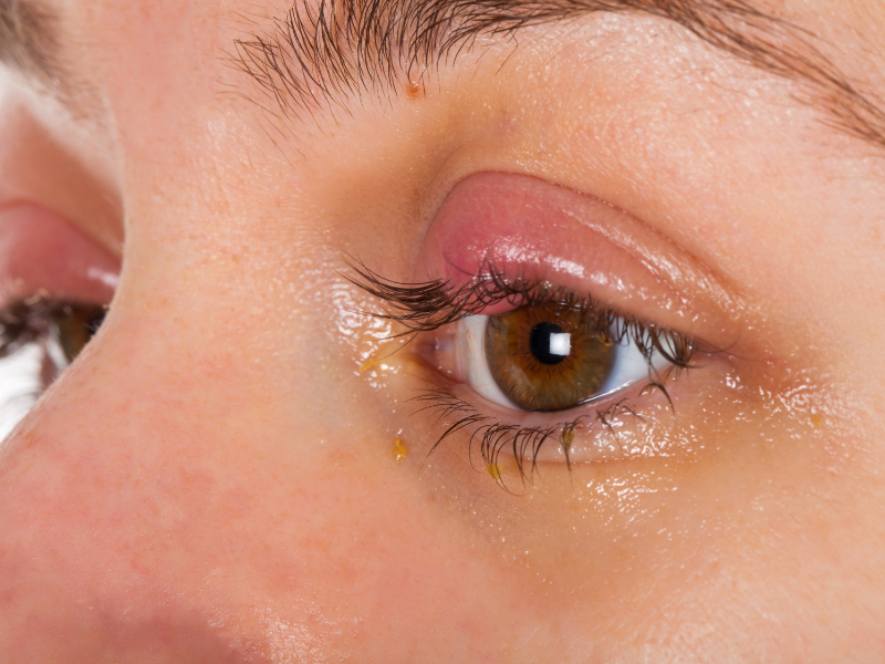 Distinguer un chalazion d'un orgelet