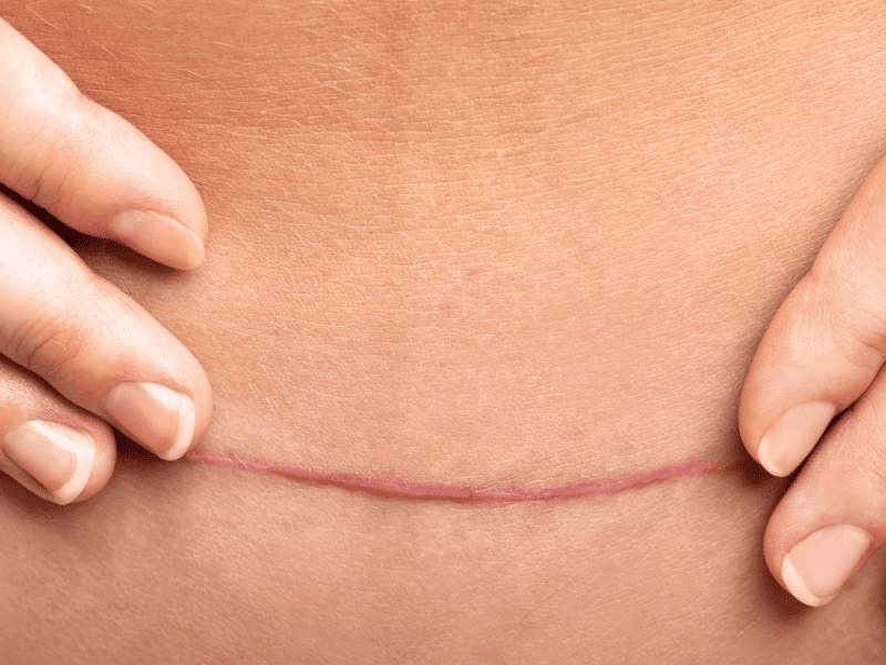 Cicatrice d'une femme ayant vécue une césarienne
