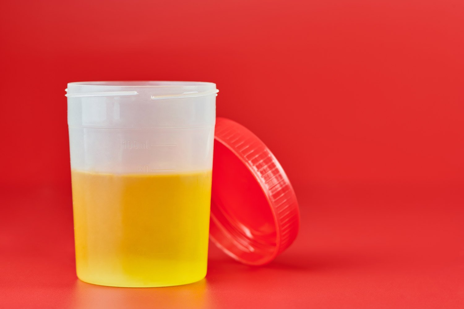 L'analyse du calcul urinaire permet de mieux traiter la colique néphrétique