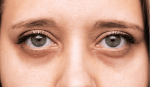 Cernes sous les yeux : causes, astuces pour les réduire