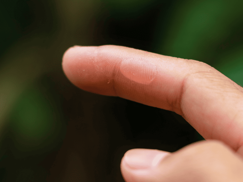 Zoom sur un doigt avec une cloque qui a besoin de soins.