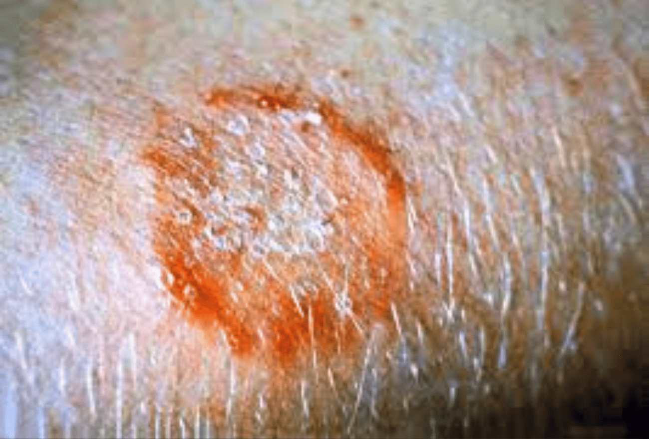 Dermatophilose humaine, nouvelle MST ?