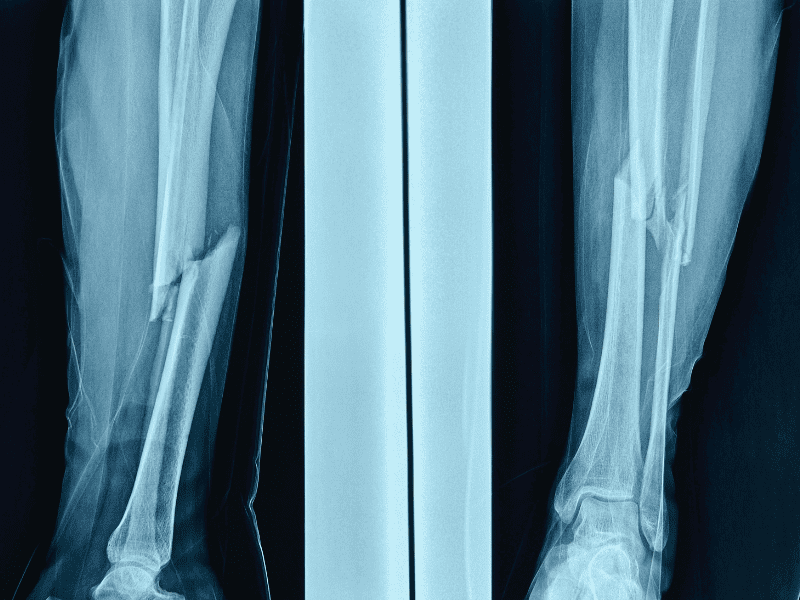 Radiographie d'une fracture de fragilité