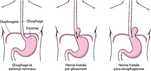 Hernie hiatale schéma sur les types 1A