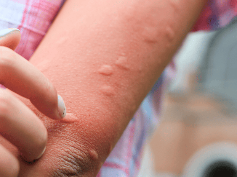 Comment bien réagir face aux moustiques, tiques, méduses et leurs soucis