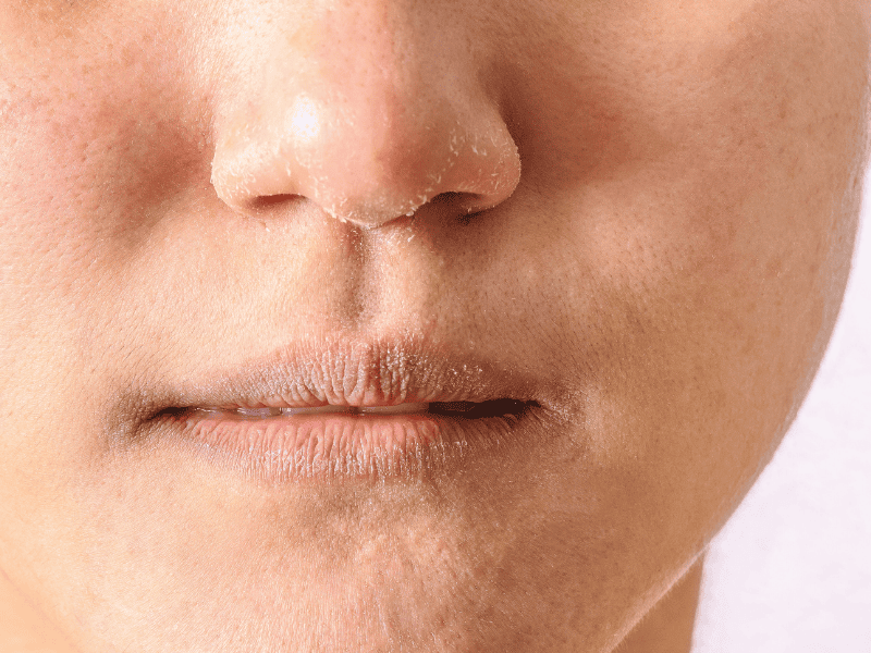 Femme ayant la peau sèche