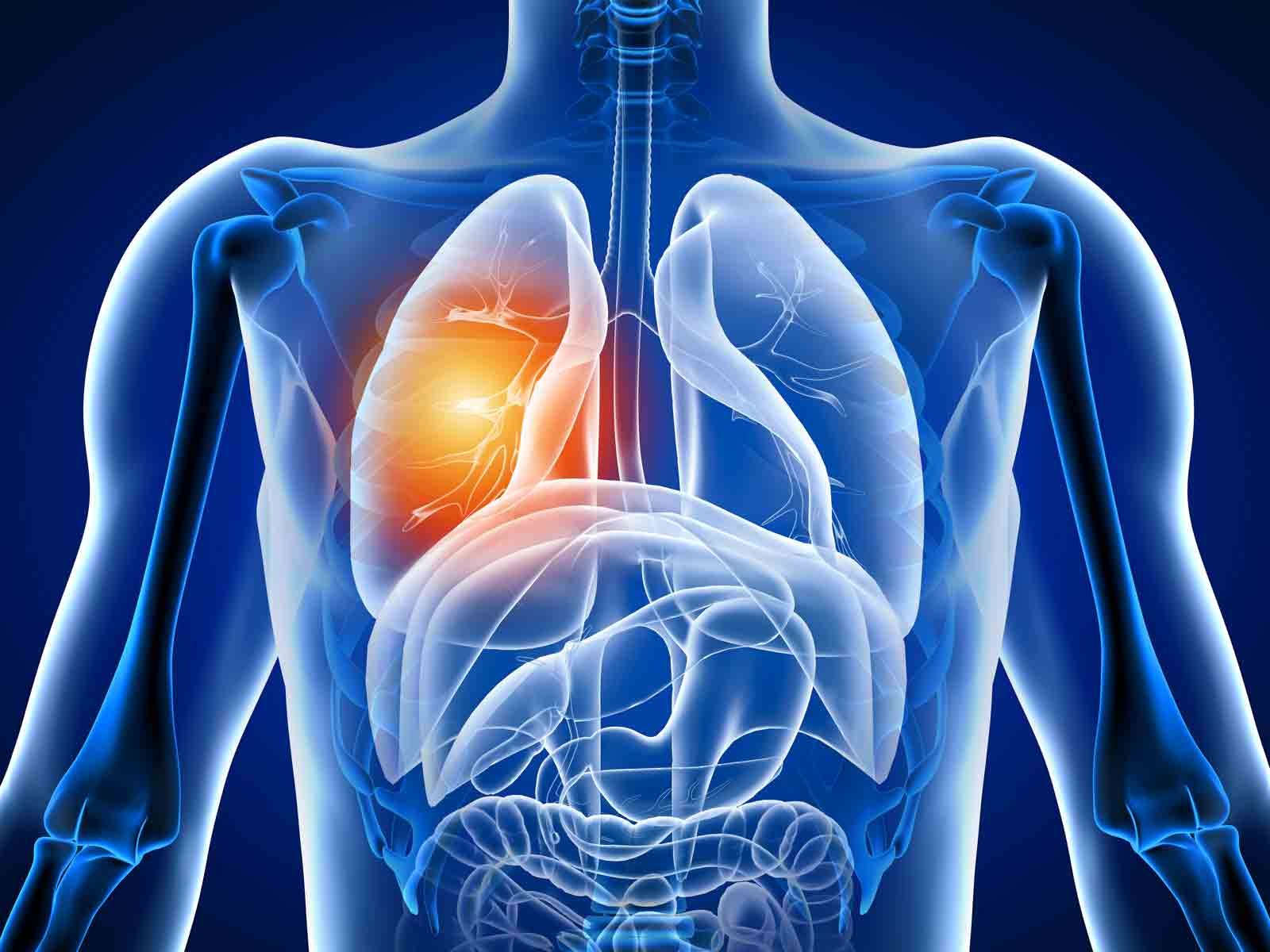 La bronchite peut être causée par une irritation des poumons 