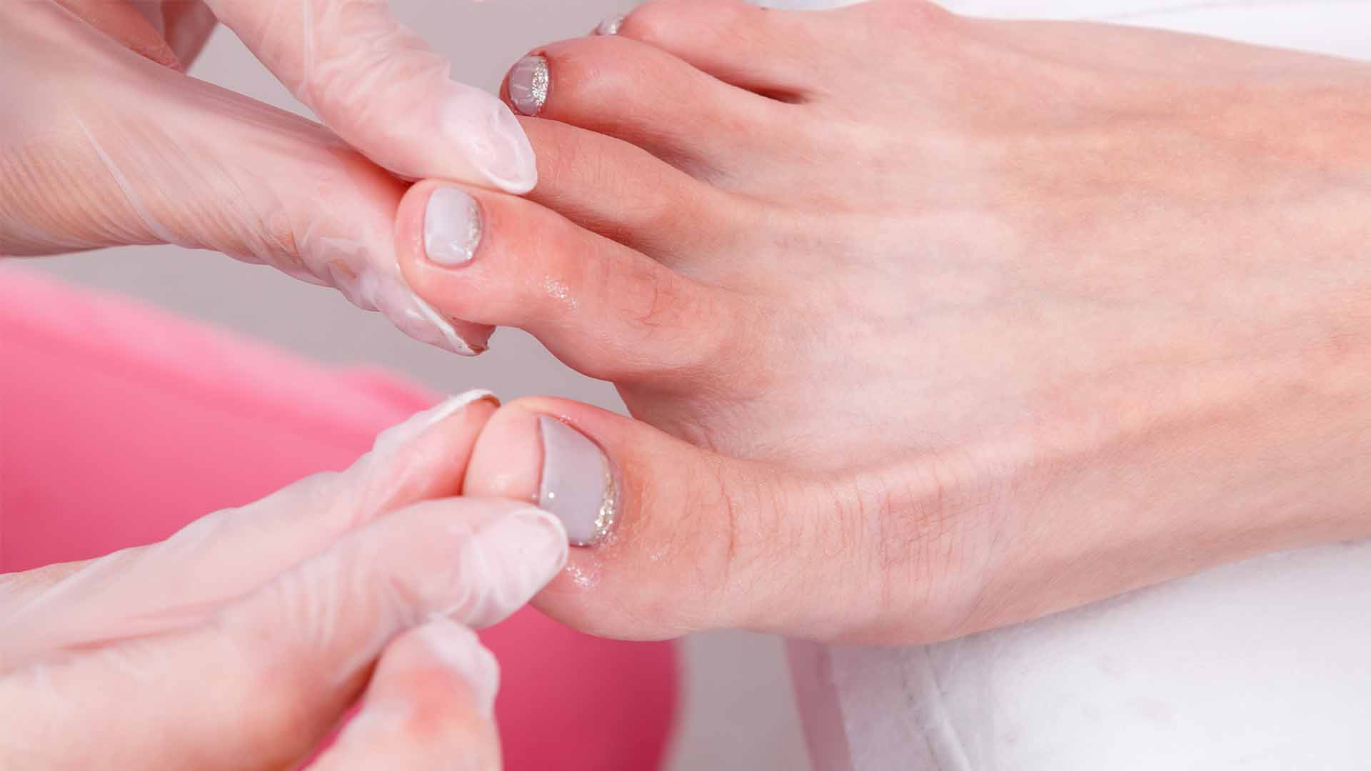 Comment reconna tre une mycose de l ongle de pied