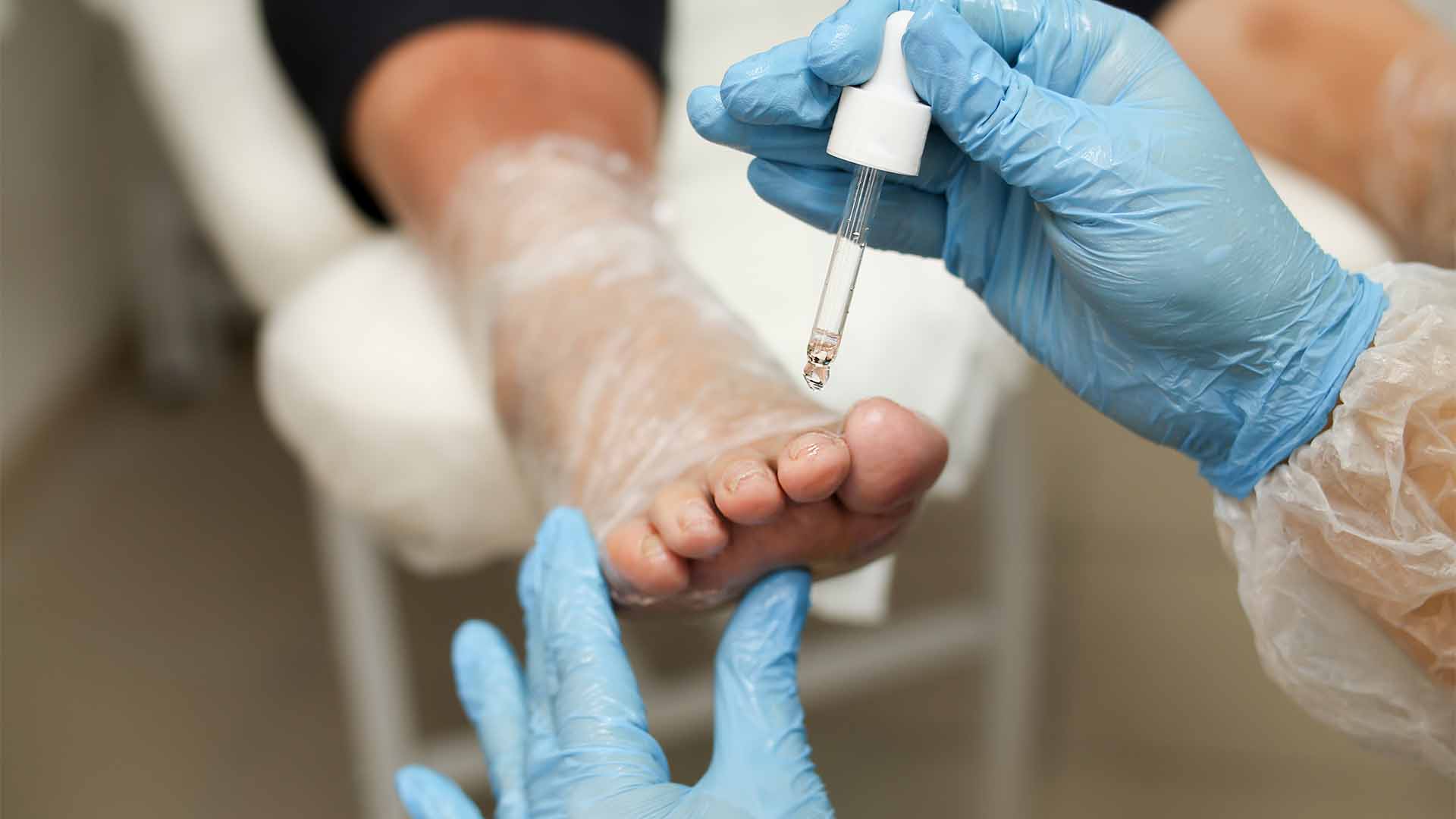 Des traitements efficaces existent pour la mycose de l'ongle de pied
