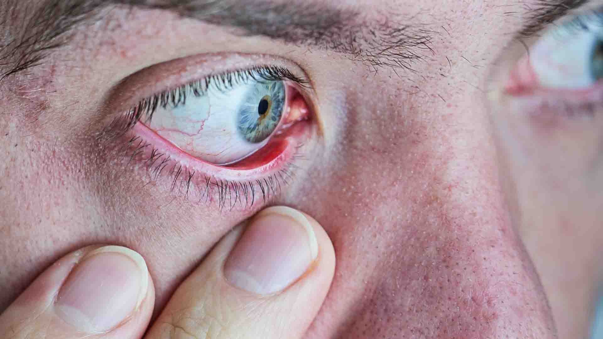 l’orgelet à l’œil provoque une rougeur