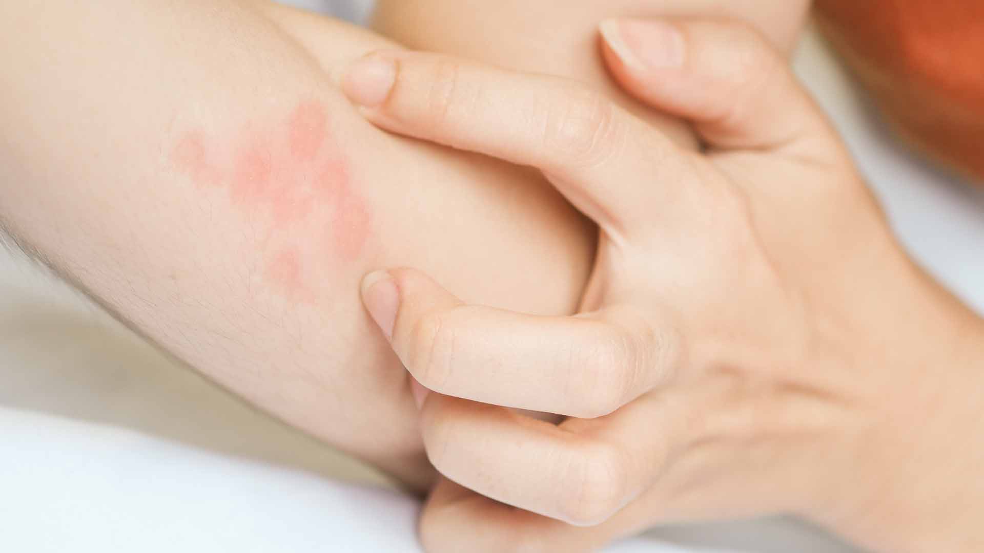 L’urticaire de stress peut être confondu avec l’eczéma