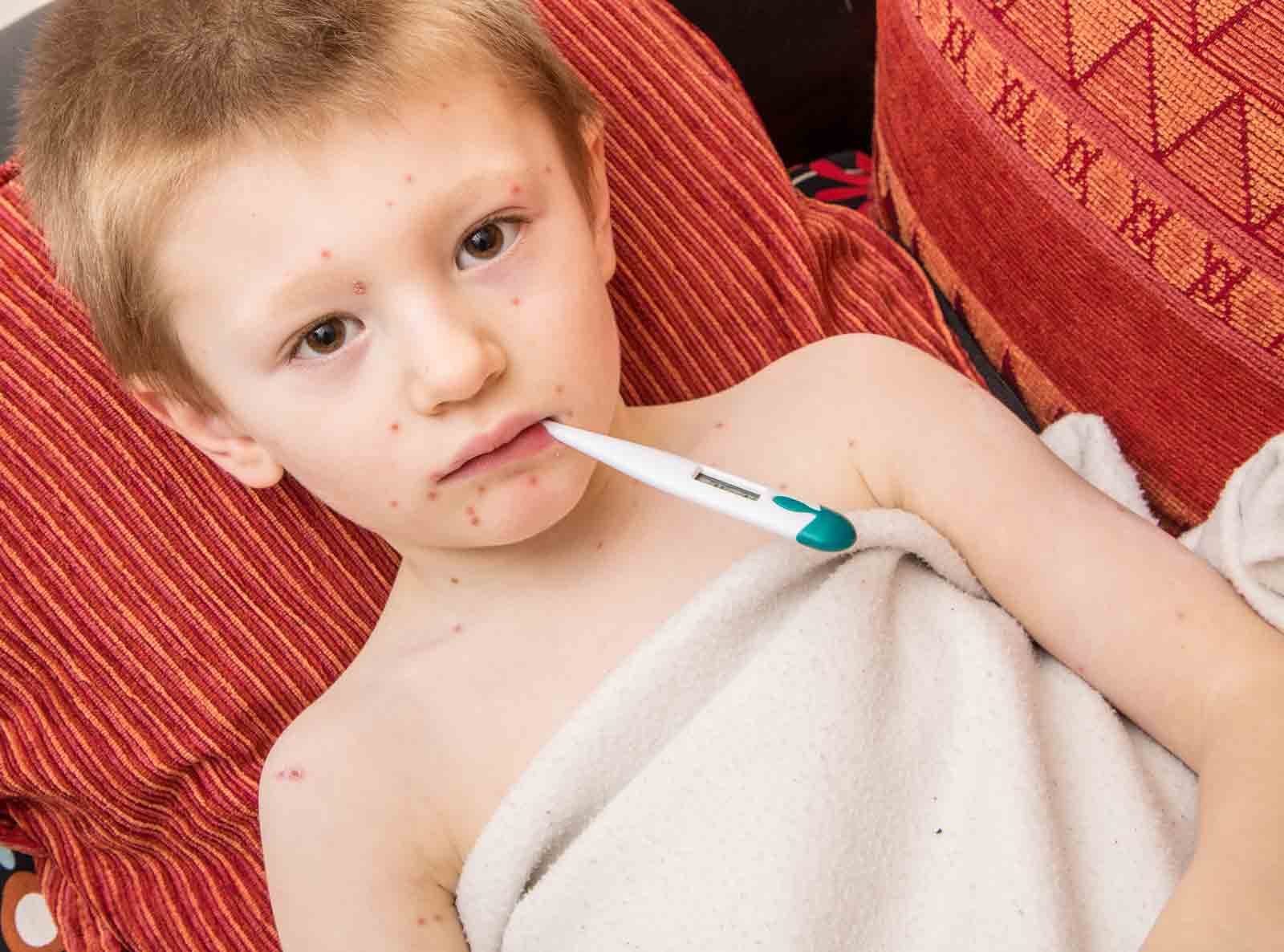 La varicelle est principalement retrouvée chez l'enfant.