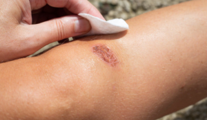 La cicatrisation est un processus naturel complexe qui intervient après une blessure ou une intervention chirurgicale.