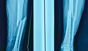 Fractures de fragilité prévenir et protéger ses os