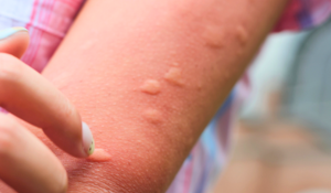 Comment bien réagir face aux moustiques, tiques, méduses