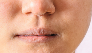 Peau sèche causes et solutions