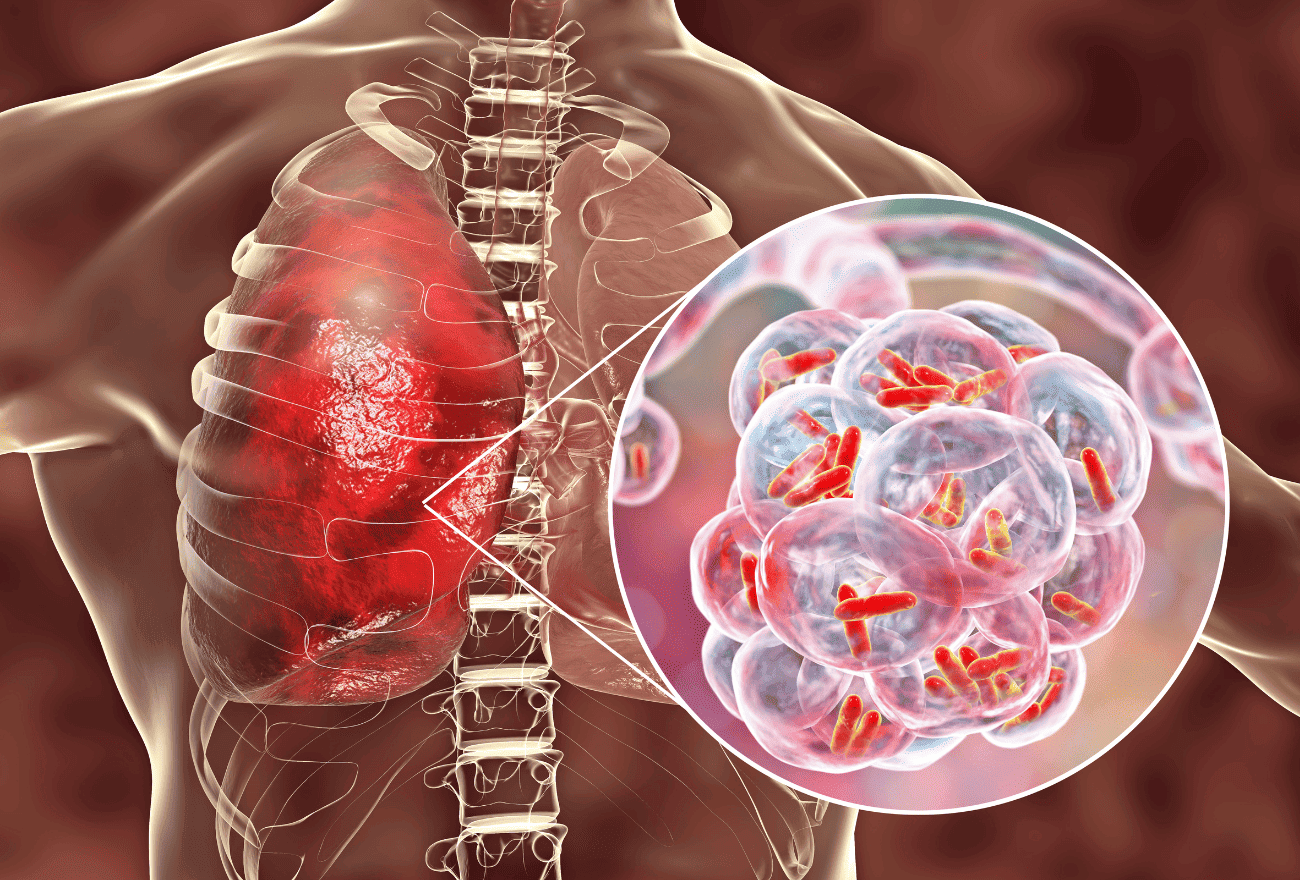 Visuel de poumons atteints d'une pneumonie