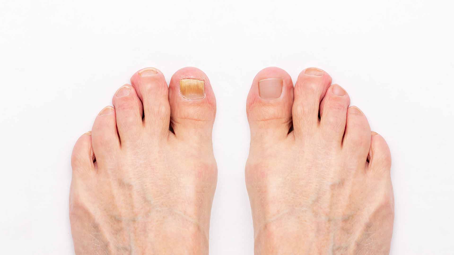 Comment reconnaître une mycose de l'ongle de pied ?