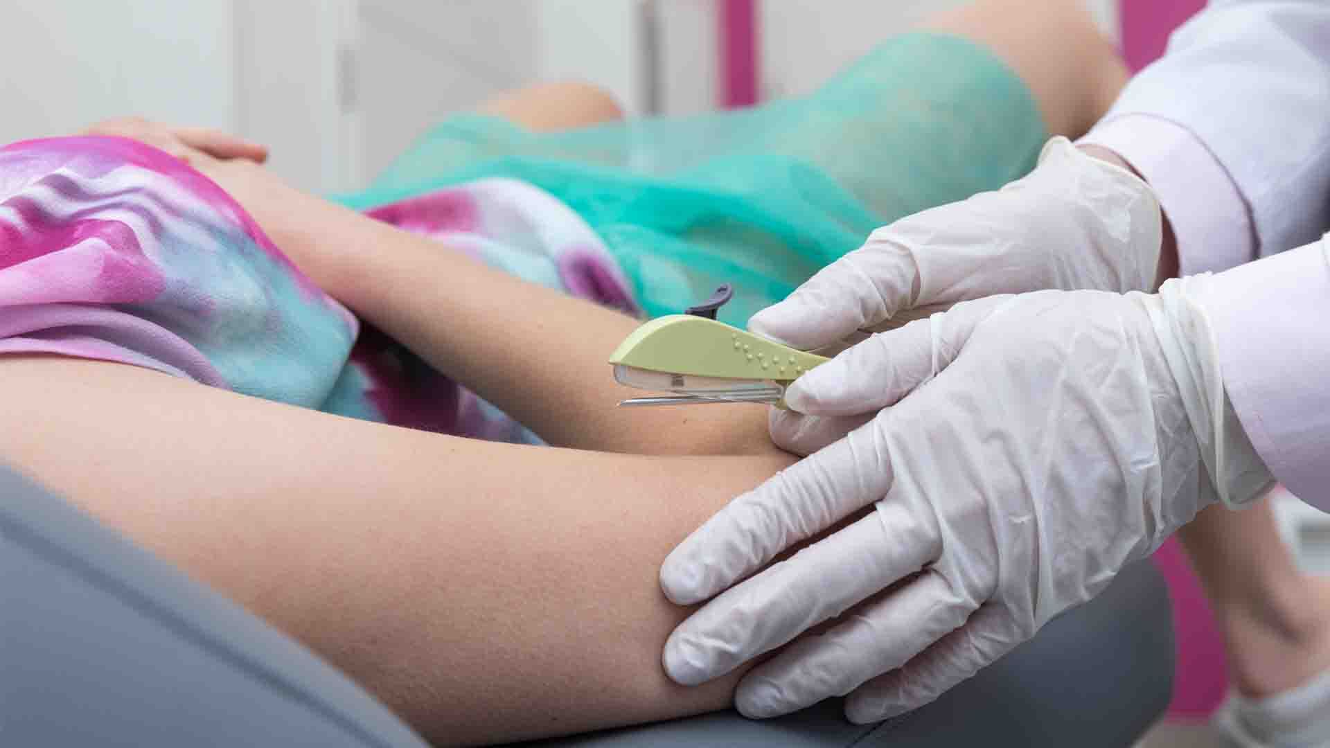pose implant contraceptif