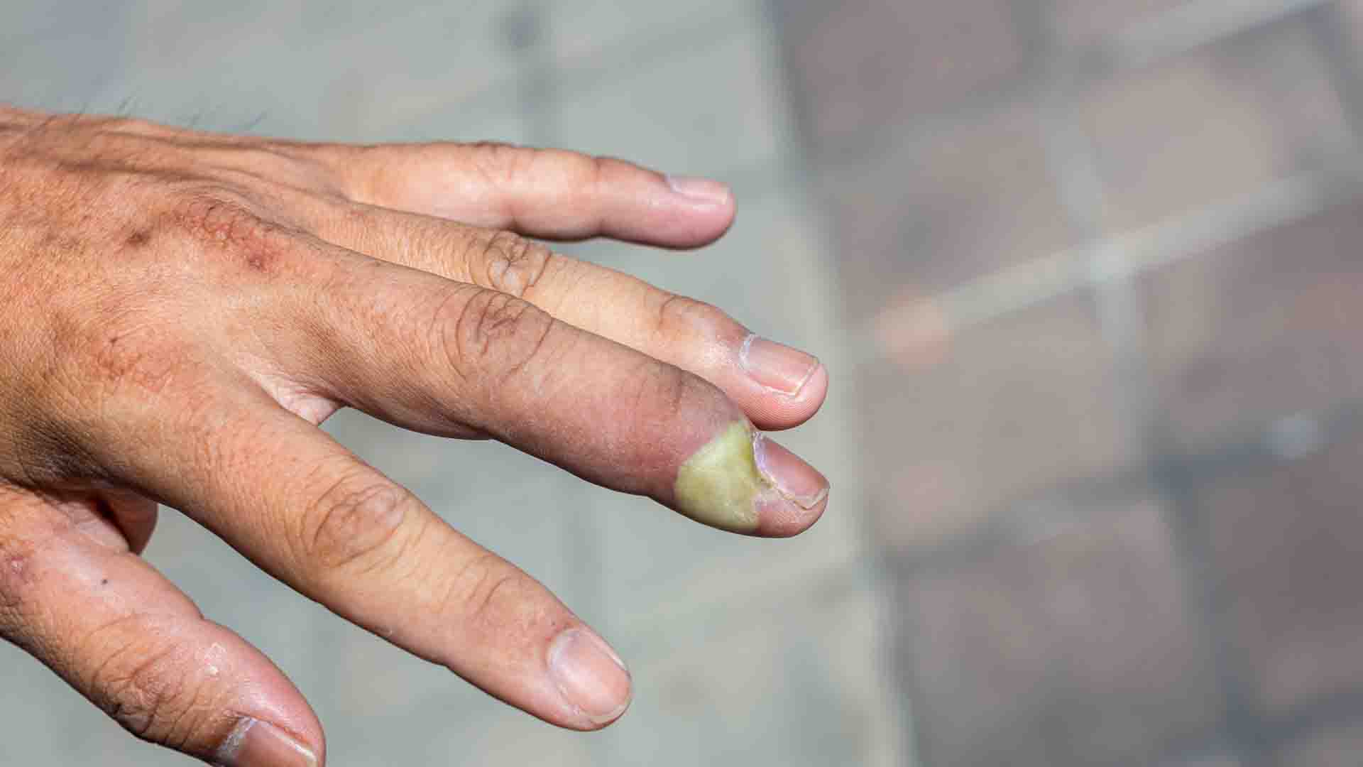 Quelles sont les causes d'un panaris au doigt ?